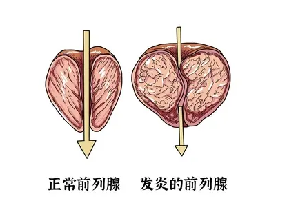 普洱茶在预防前列腺炎中对女性的影响：一项研究报告