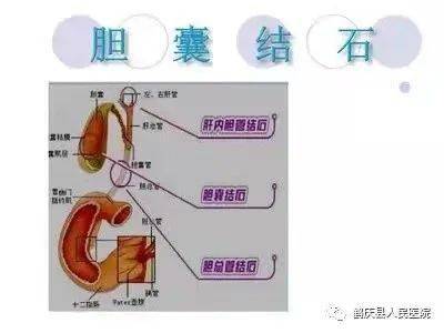 切除胆囊后的日常生活：饮茶禁忌与恢复指南