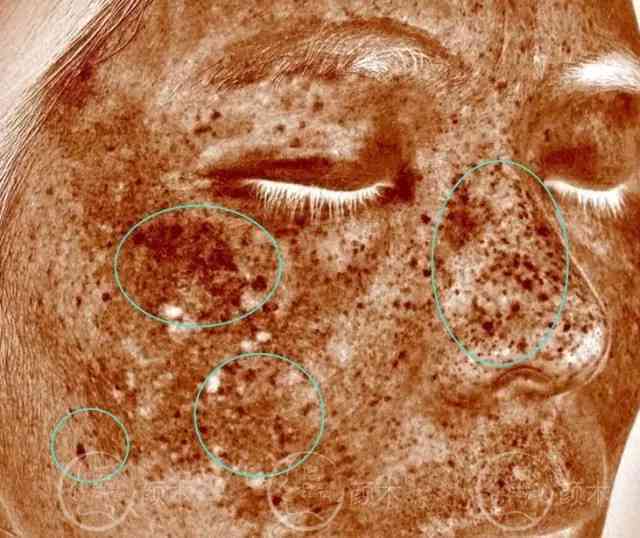 棕色小斑点的成因、症状和治疗方法：一篇全面的指南