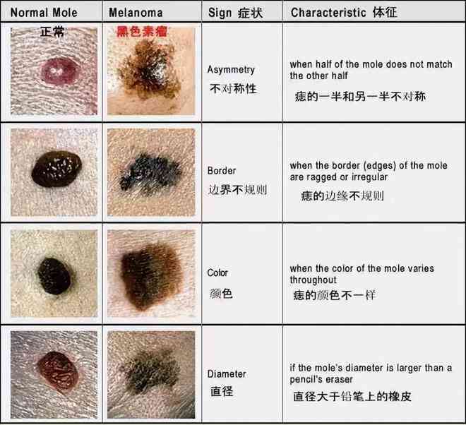 祛痣喝普洱茶留下色素沉着怎么办？