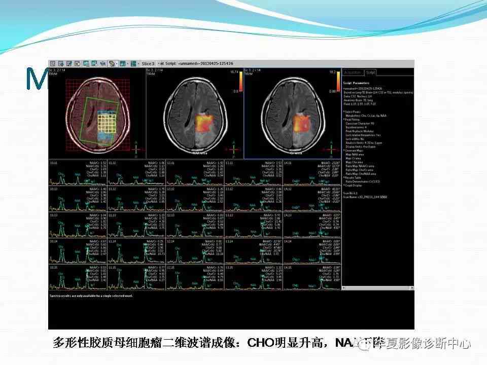 磁共振成像技术在疾病诊断中的应用和注意事项