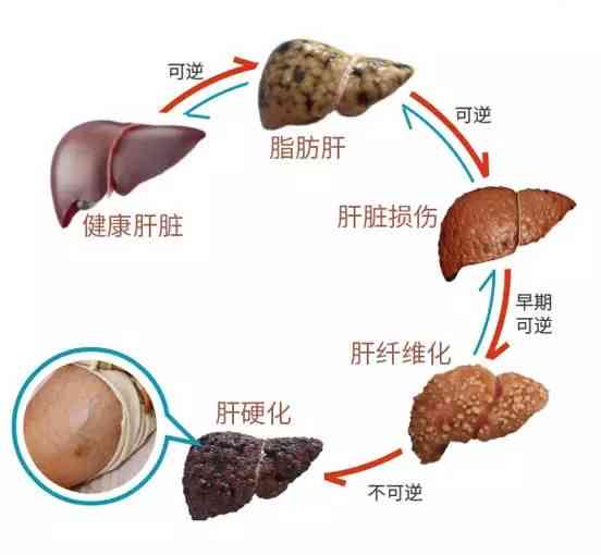 普洱茶对肝炎患者的影响及饮用适宜性：一份全面的指南