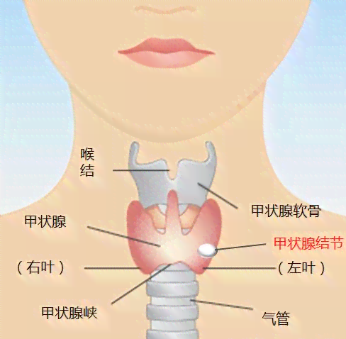 佩戴玉坠项链是否会影响甲状腺健康：探讨结节与甲状的关系