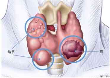 脖子上挂玉坠会影响甲状腺结节吗