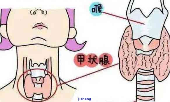 桥本氏甲状腺炎患者：喝茶是否有益健？医生权威解答