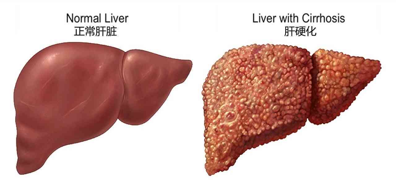 肝硬化患者的饮食调控：适宜与应避免的食物