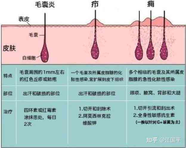 新毛囊炎的治疗方法及普洱茶对病情的影响，女生是否适合饮用？