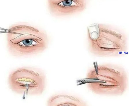 翡翠蛋面双眼皮：原理、适用人群、手术风险及恢复期全面解析