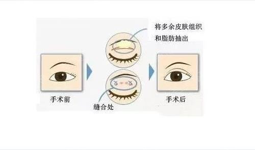 翡翠蛋面双眼皮：原理、适用人群、手术风险及恢复期全面解析