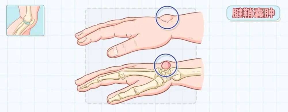 戴玉镯治疗腱鞘囊肿：一种神秘而有效的自然疗法？