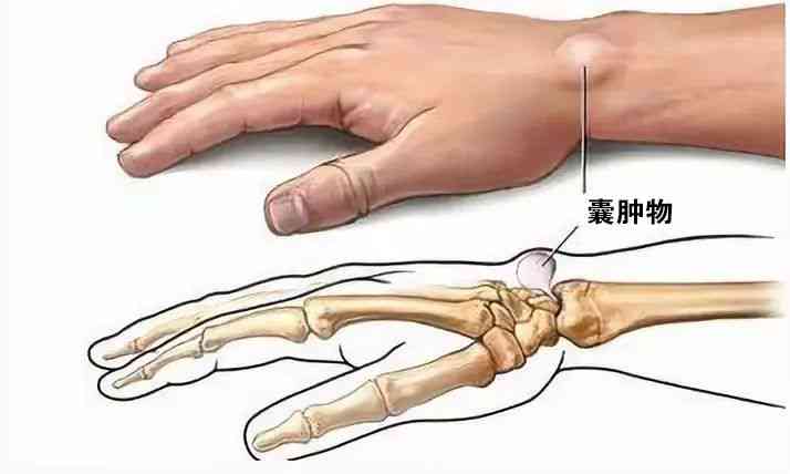 戴玉镯治疗腱鞘囊肿：一种神秘而有效的自然疗法？