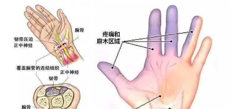 戴玉镯后腱鞘炎消失？试试这些方法，全面缓解疼痛和炎症！