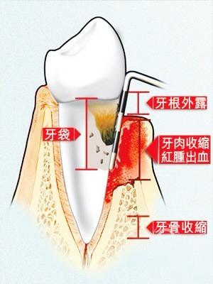 普洱茶对牙龈出血的影响：原因、解决方法与预防措