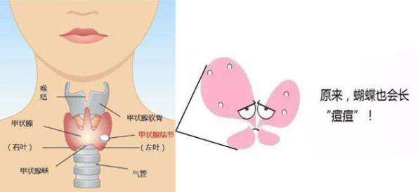 喝普洱茶导致甲状腺结节