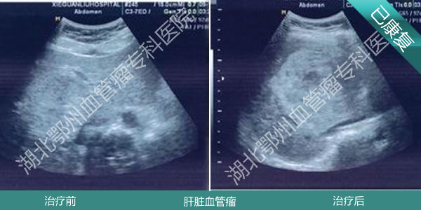 关于肝血管瘤患者是否适宜饮茶：完整信息及影响分析