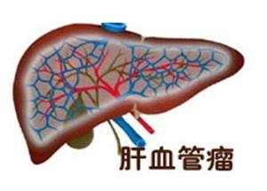 普洱茶与肝血管瘤：女性患者是否应饮用的科学探讨