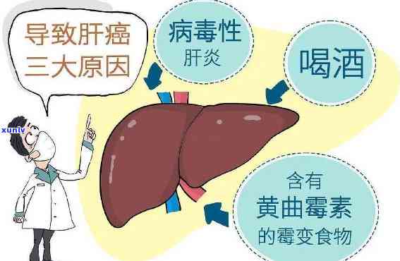 肝血管瘤患者饮茶：适宜与禁忌