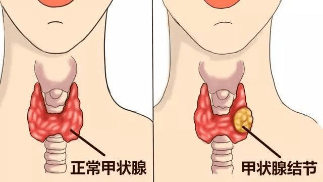 戴翡翠吊坠对甲状腺结节的影响：科学解释与建议