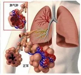 哮喘性支气管炎患者喝普洱茶的好处及注意事项