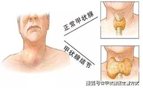 佩戴玉石项链对甲状腺结节患者的影响：专家解读与建议