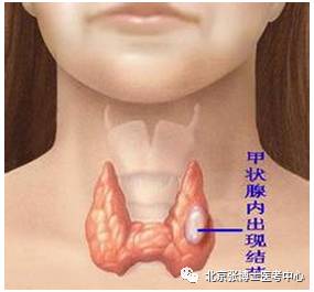 佩戴适合的项链可改善甲状腺结节症状：选择、建议与注意事项