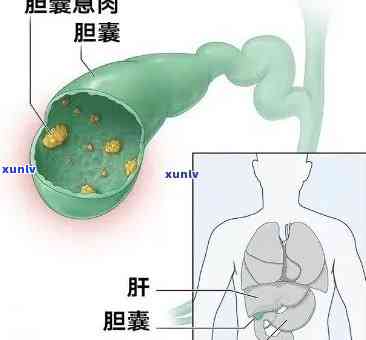 胆囊息肉患者是否可以饮用熟普洱茶以及其对健的影响？