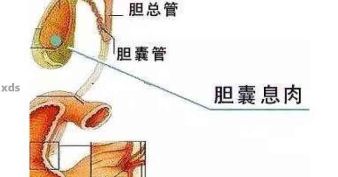 胆囊息肉患者是否可以饮用熟普洱茶以及其对健的影响？