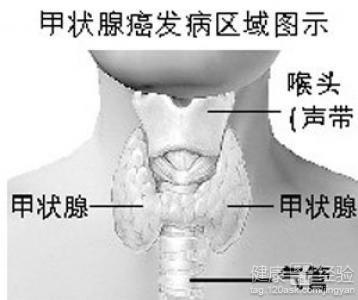 甲状腺癌手术后能喝红茶吗