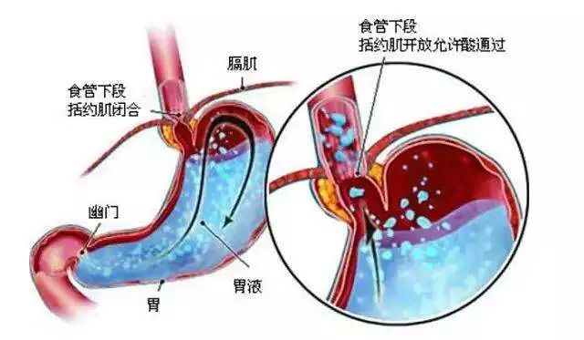 普洱茶：对胃反流症状的有效性和可能的副作用全面解析