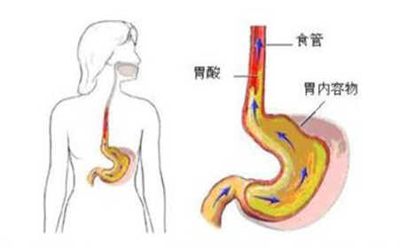 普洱茶与食道反流症：能否饮用及其影响，你需要了解的一切