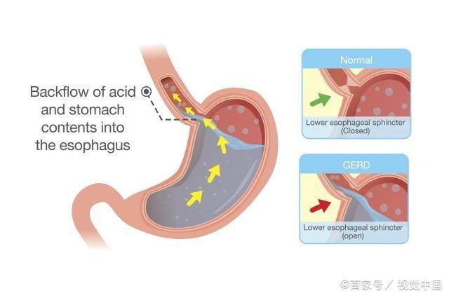 普洱茶与食道反流症：能否饮用及其影响，你需要了解的一切