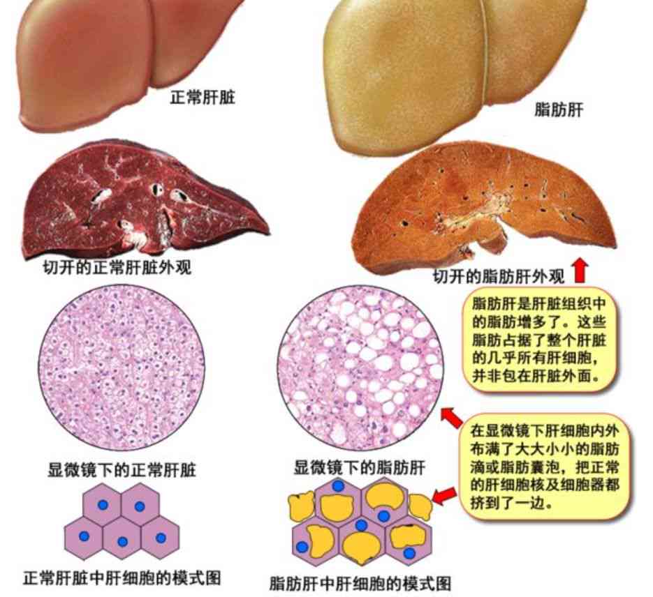 如何选择对高血脂和脂肪肝有显著改善效果的茶叶？