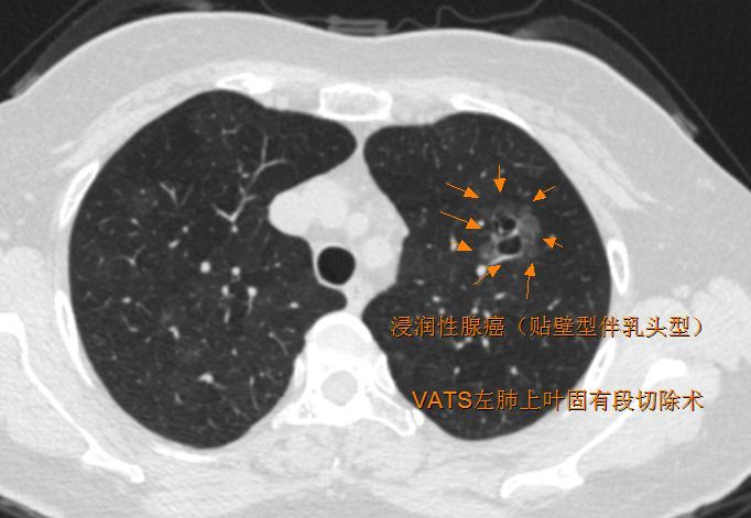 什么茶可以帮助消除肺部结节？