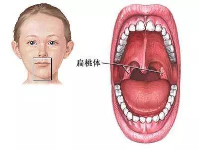 普洱茶能治疗扁桃体肥大吗