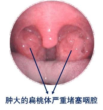 普洱茶能治疗扁桃体肥大吗