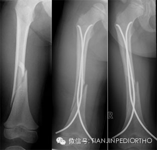 骨折恢复期：普洱茶对女生健的影响及适宜度探究