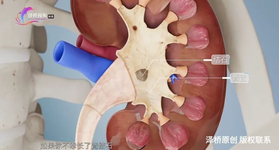 选择何种茶叶有助于肾结石的改善与预防？