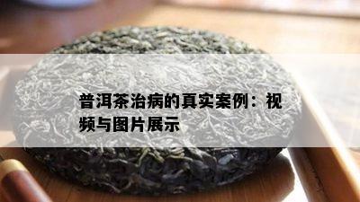 普洱茶治病的真实案例：视频与图片展示