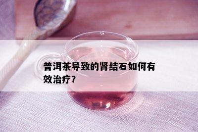 普洱茶导致的肾结石如何有效治疗？