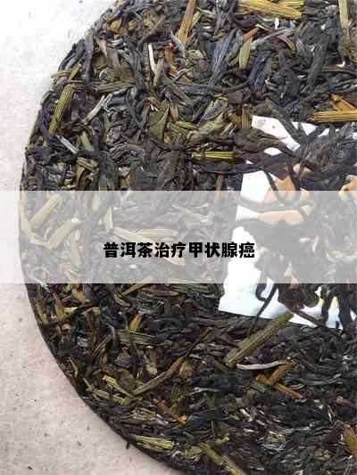 普洱茶治疗甲状腺癌